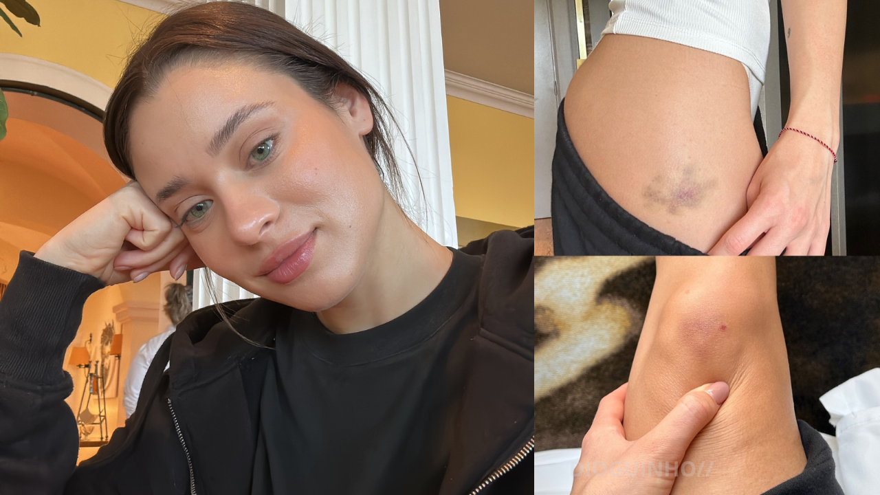 Daniela Melchior marca fim de gravações de "A Night in Porto" com hematomas à vista